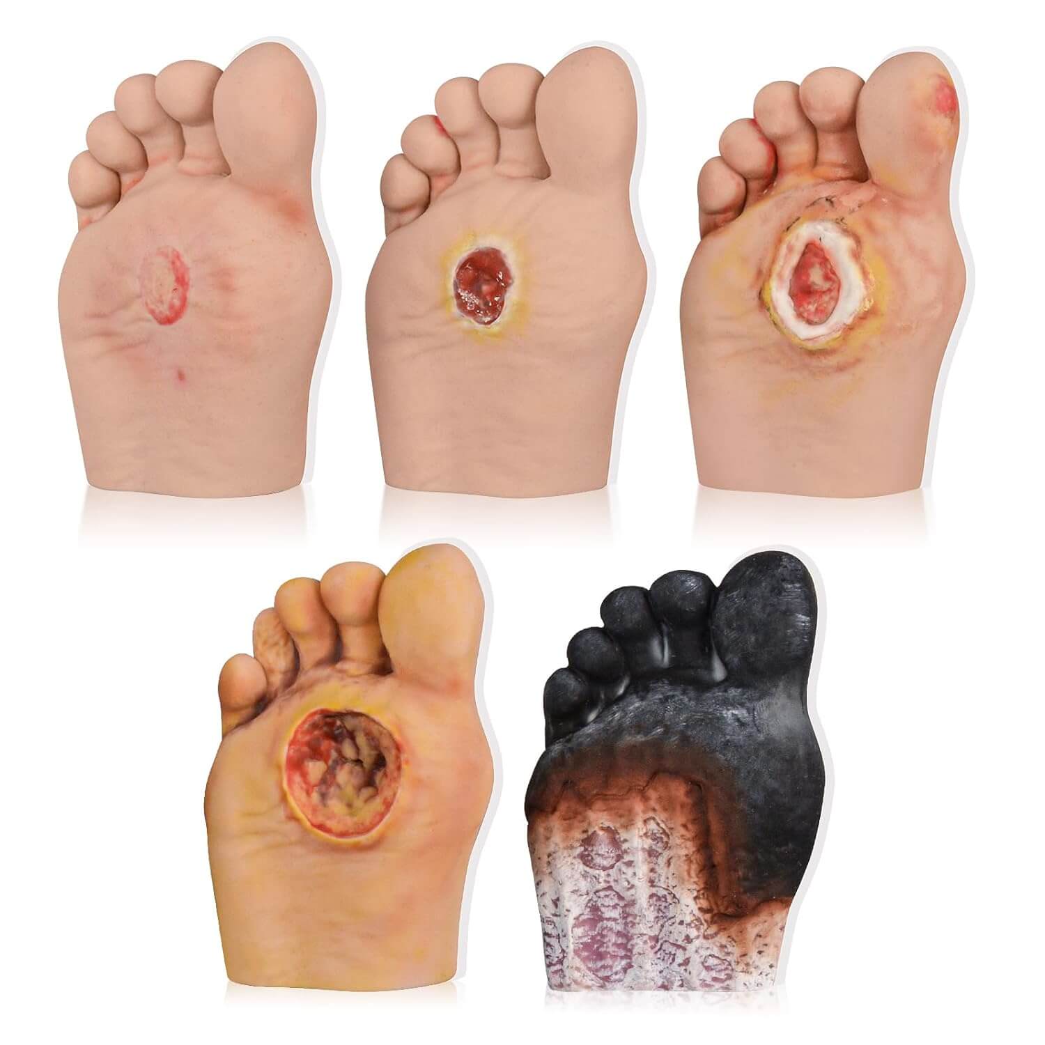 Ultrassist Diabetic Foot Ulcer Grading Model Set - 5 Stages Diabetes Complication Simulator
