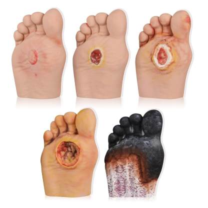 Ultrassist Diabetic Foot Ulcer Grading Model Set - 5 Stages Diabetes Complication Simulator