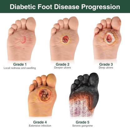 Ultrassist Diabetic Foot Ulcer Grading Model Set - 5 Stages Diabetes Complication Simulator