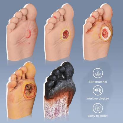 Ultrassist Diabetic Foot Ulcer Grading Model Set - 5 Stages Diabetes Complication Simulator