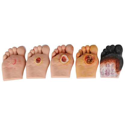 Ultrassist Diabetic Foot Ulcer Grading Model Set - 5 Stages Diabetes Complication Simulator