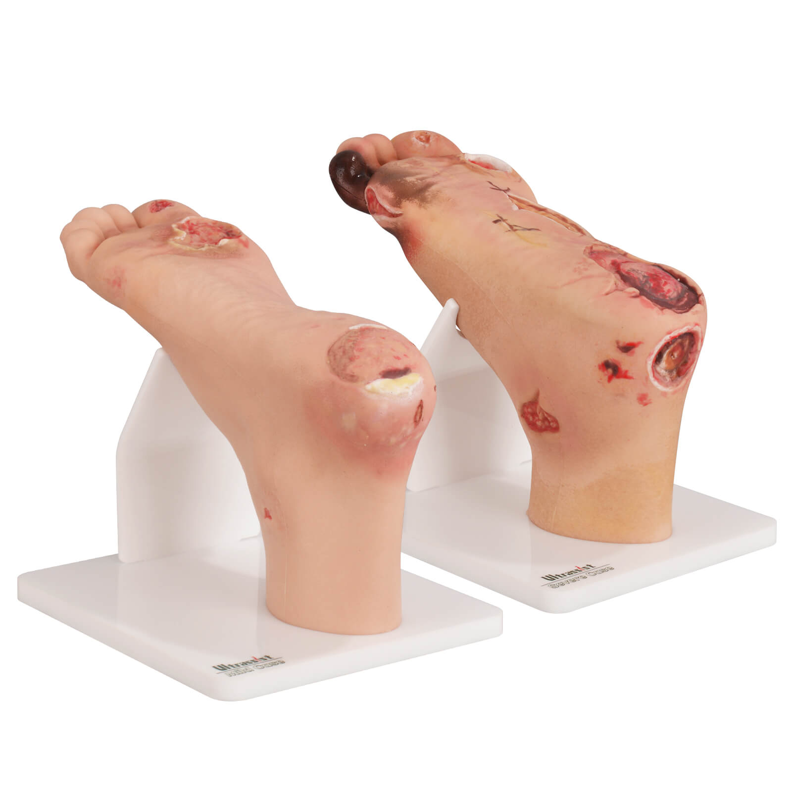 Ultrassist Diabetic Foot Ulcer Model Set, Mild & Severe Stages