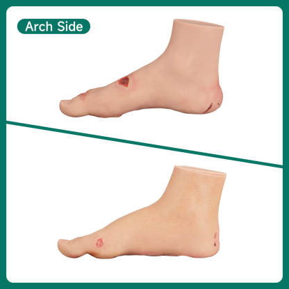 Ultrassist Diabetic Foot Ulcer Model Set, Mild & Severe Stages