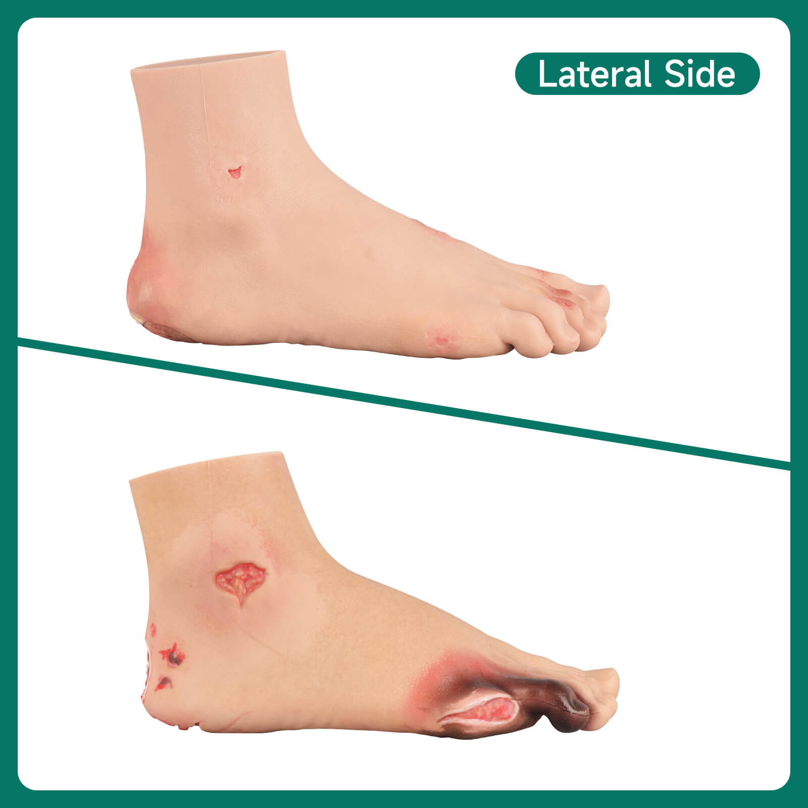 Ultrassist Diabetic Foot Ulcer Model Set, Mild & Severe Stages