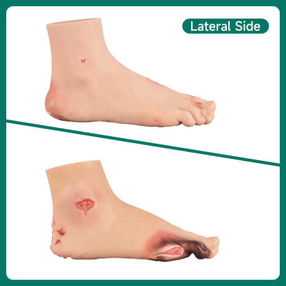 Ultrassist Diabetic Foot Ulcer Model Set, Mild & Severe Stages