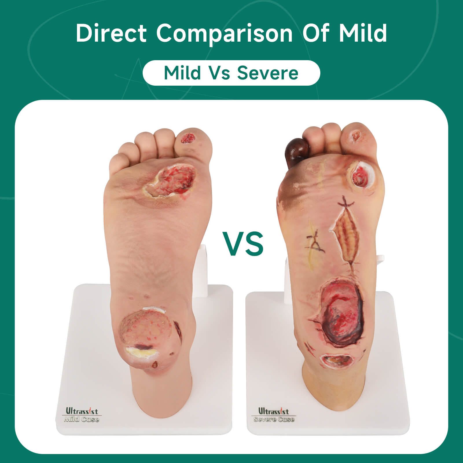 Ultrassist Diabetic Foot Ulcer Model Set, Mild & Severe Stages