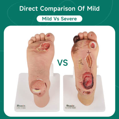 Ultrassist Diabetic Foot Ulcer Model Set, Mild & Severe Stages