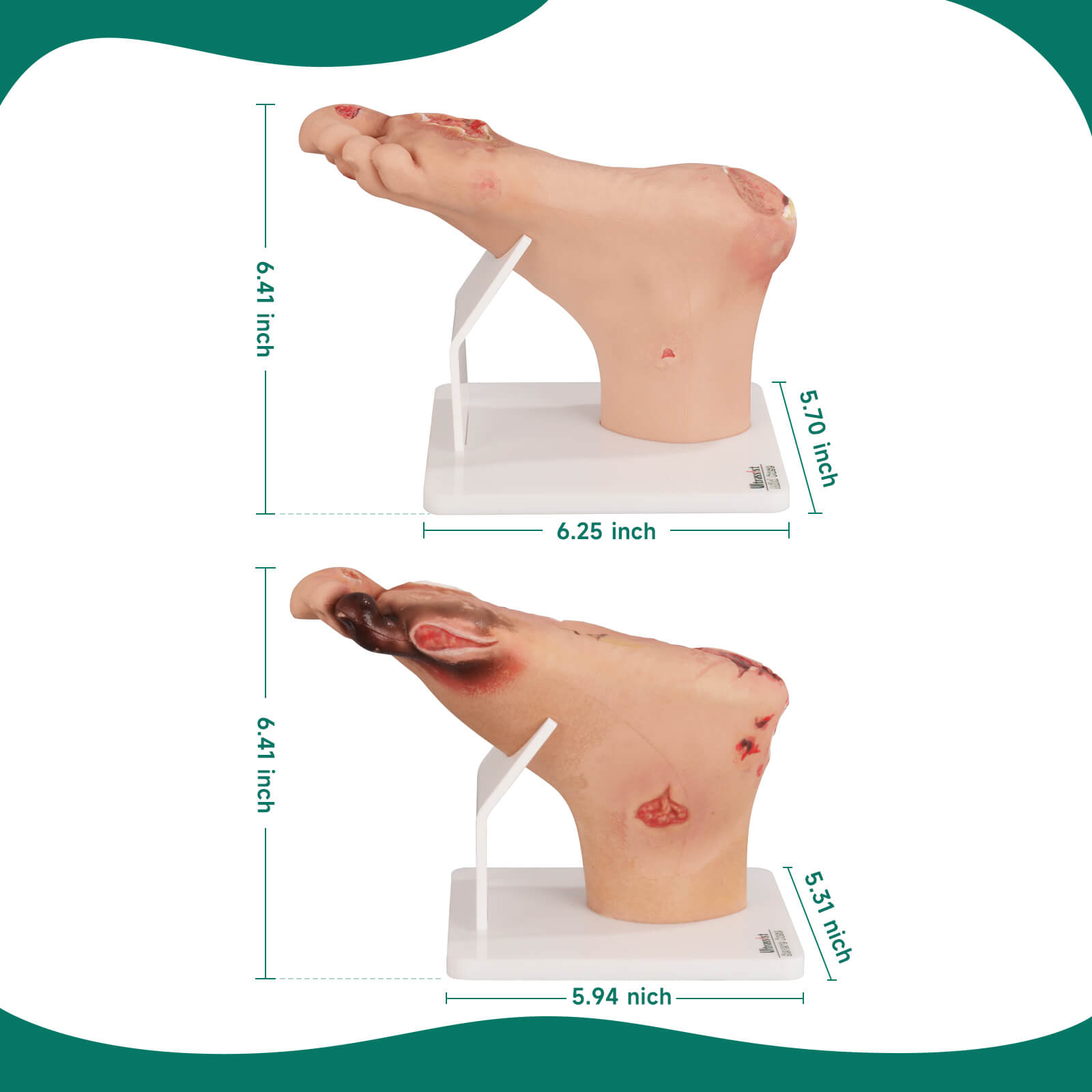 Ultrassist Diabetic Foot Ulcer Model Set, Mild & Severe Stages
