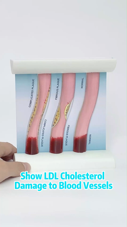 LDL Cholesterol Blood Vessel Model: Normal vs Plaque Stages
