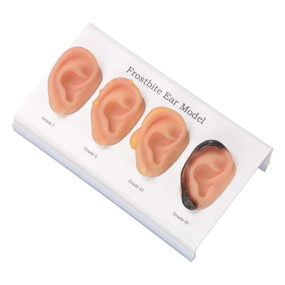 ear frostbite model set, Grade I to IV