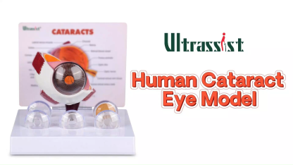 Enlarged Human Cataract Eye Anatomy Model for Ophthalmology Education