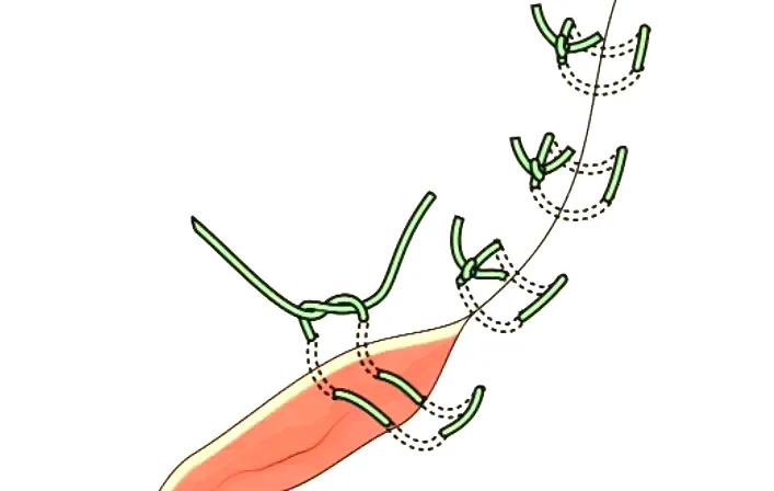 suture en matelas horizontal 