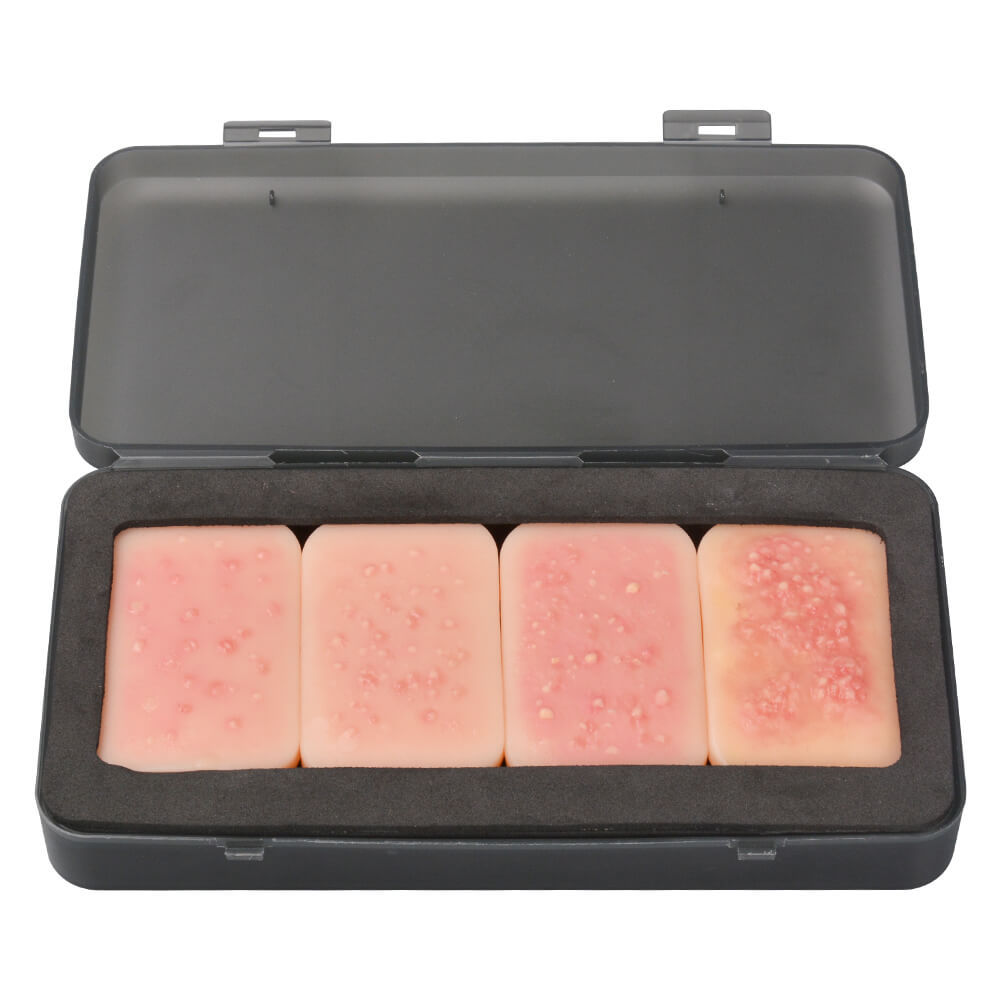 facial acne stages model, stage I - IV