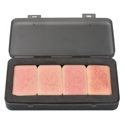 facial acne stages model, stage I - IV