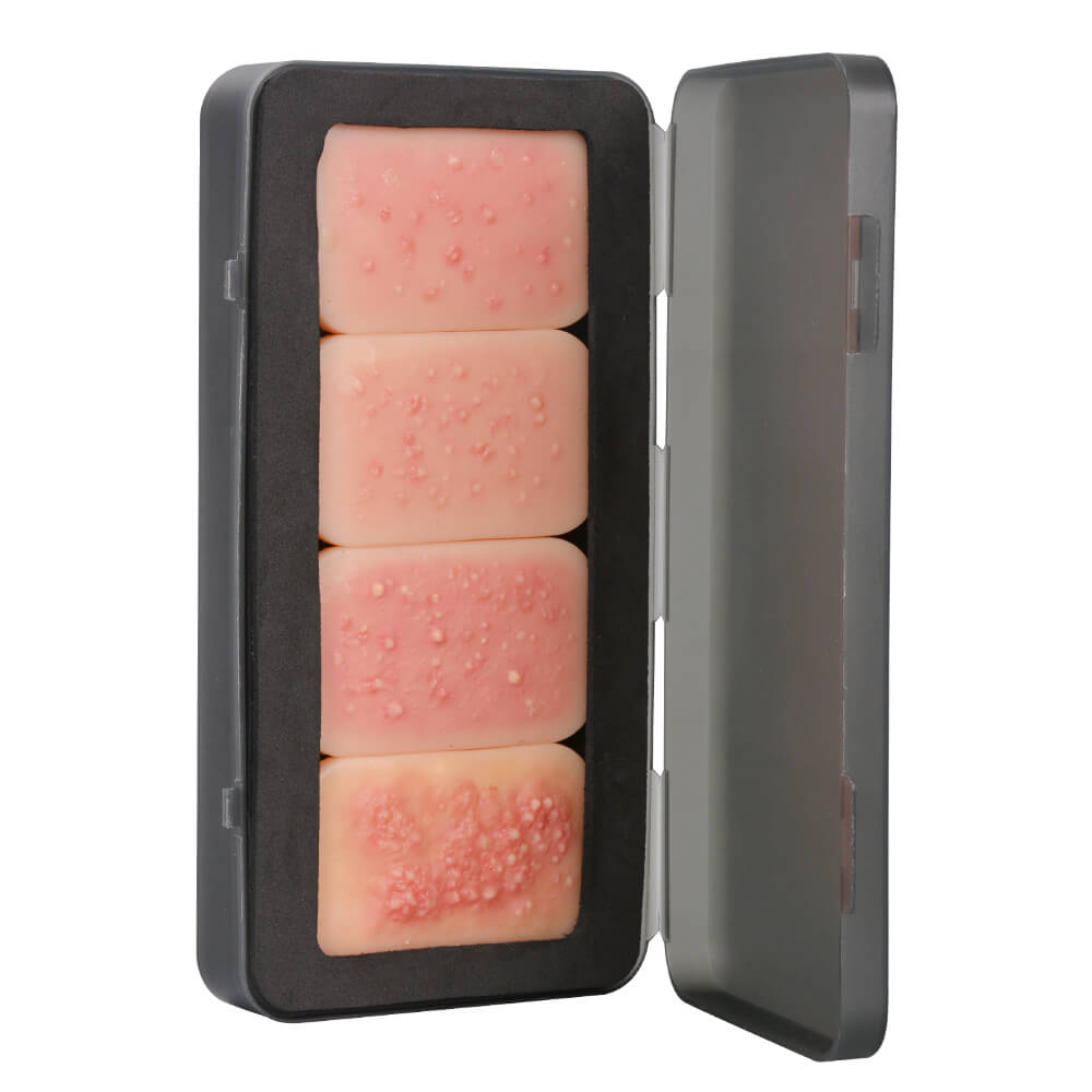 facial acne pregression model set of 4