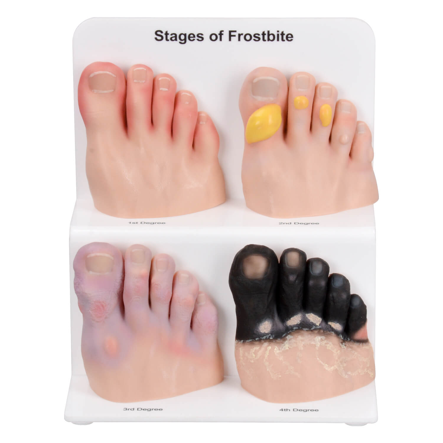 Foot Toe Frostbite Model Set of 4 (Grades 1–4)