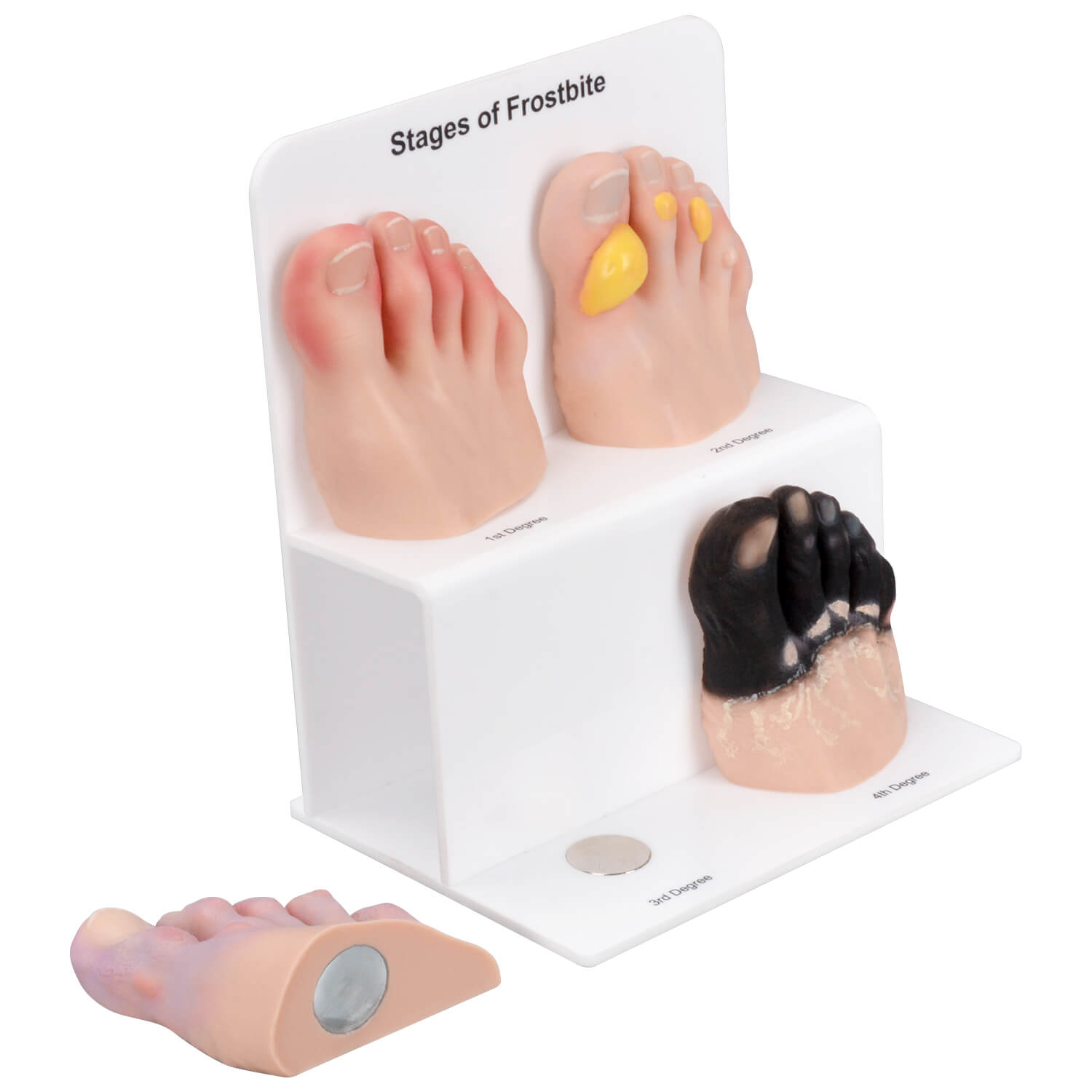 Foot Toe Frostbite Model Set of 4 (Grades 1–4)