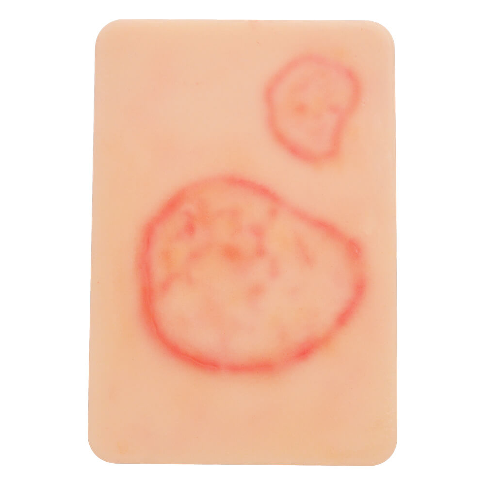 Fungal Skin Infection Wound Model Set (2 Pieces)