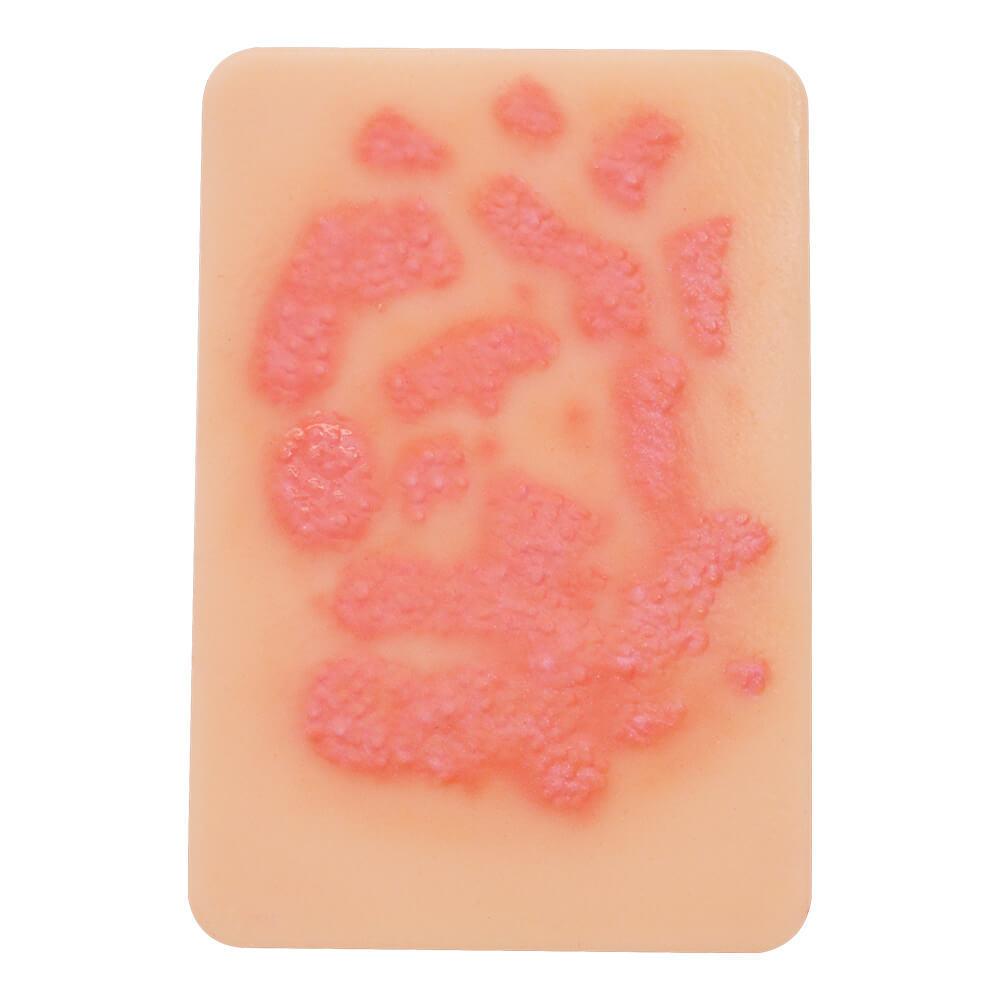 Fungal Skin Infection Wound Model Set (2 Pieces)