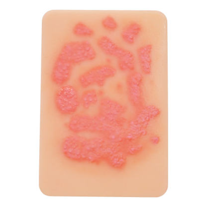 Fungal Skin Infection Wound Model Set (2 Pieces)