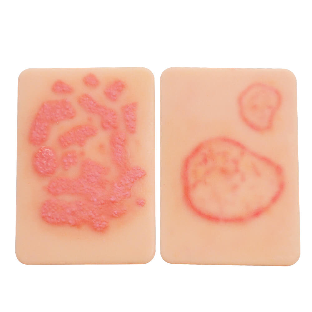 Fungal Skin Infection Wound Model Set (2 Pieces)