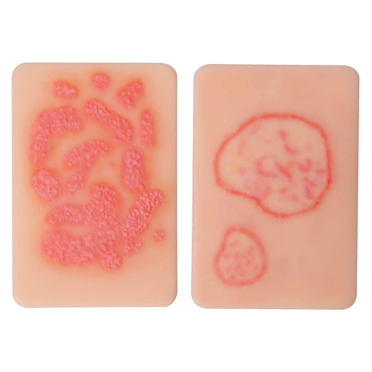 Fungal Skin Infection Wound Simulation Models (Set of 2)