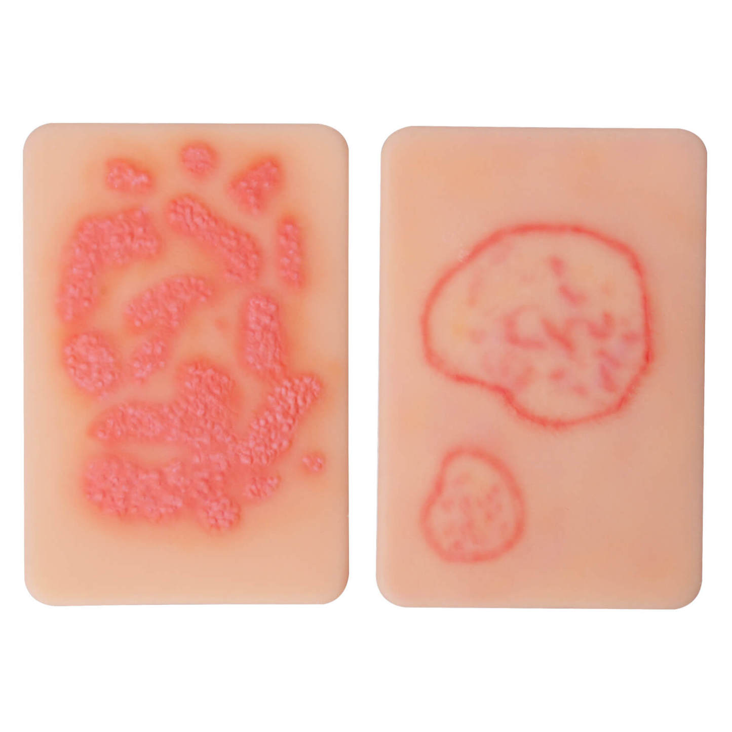 Fungal Skin Infection Wound Simulation Models (Set of 2)