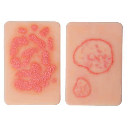 Fungal Skin Infection Wound Simulation Models (Set of 2)