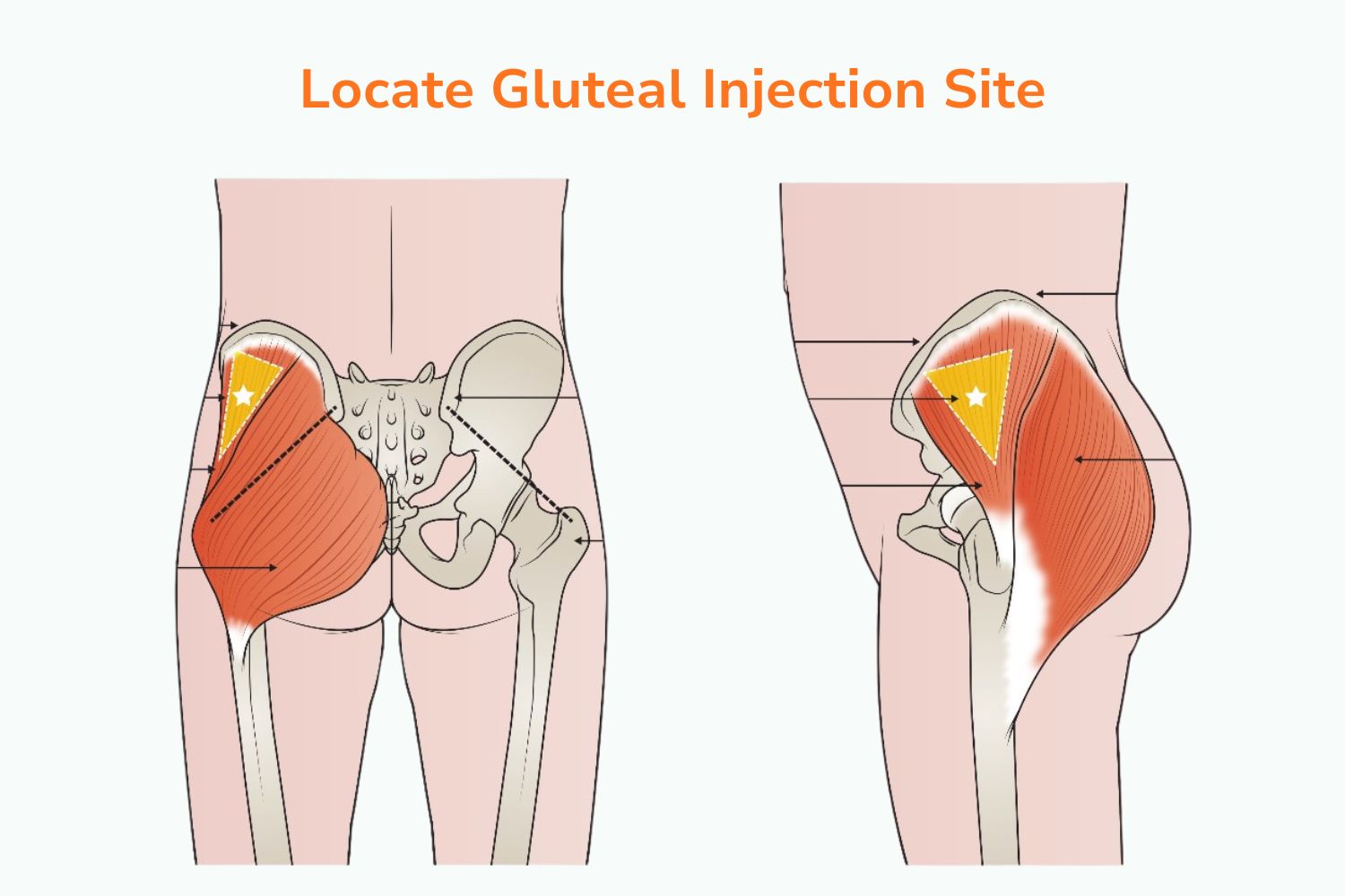 Gluteal Injection Sites