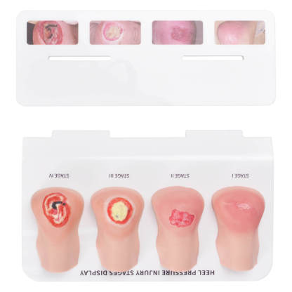 Heel Pressure Injury Stages Display Model (Stage I–IV)