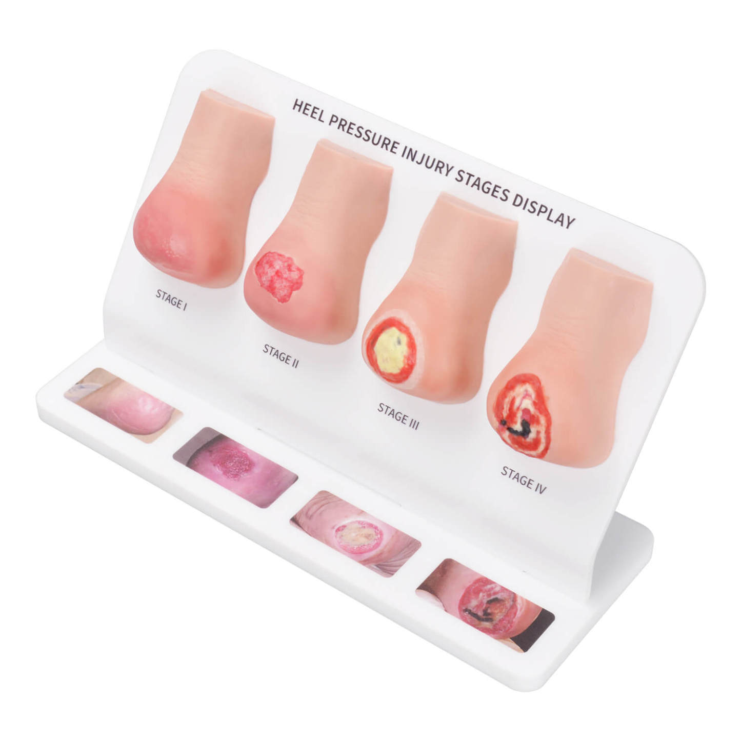 Heel Pressure Injury Display Model (Stage I–IV)