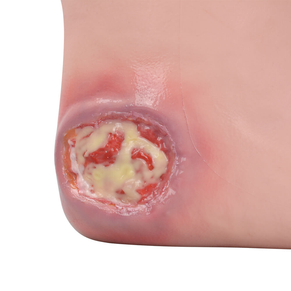 Heel Pressure Ulcer Nursing Training Model (Wearable Sock-Style)