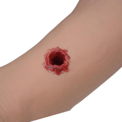 Ultrassist Multi-Wound Hemorrhage Control Arm with Gunshot Wounds