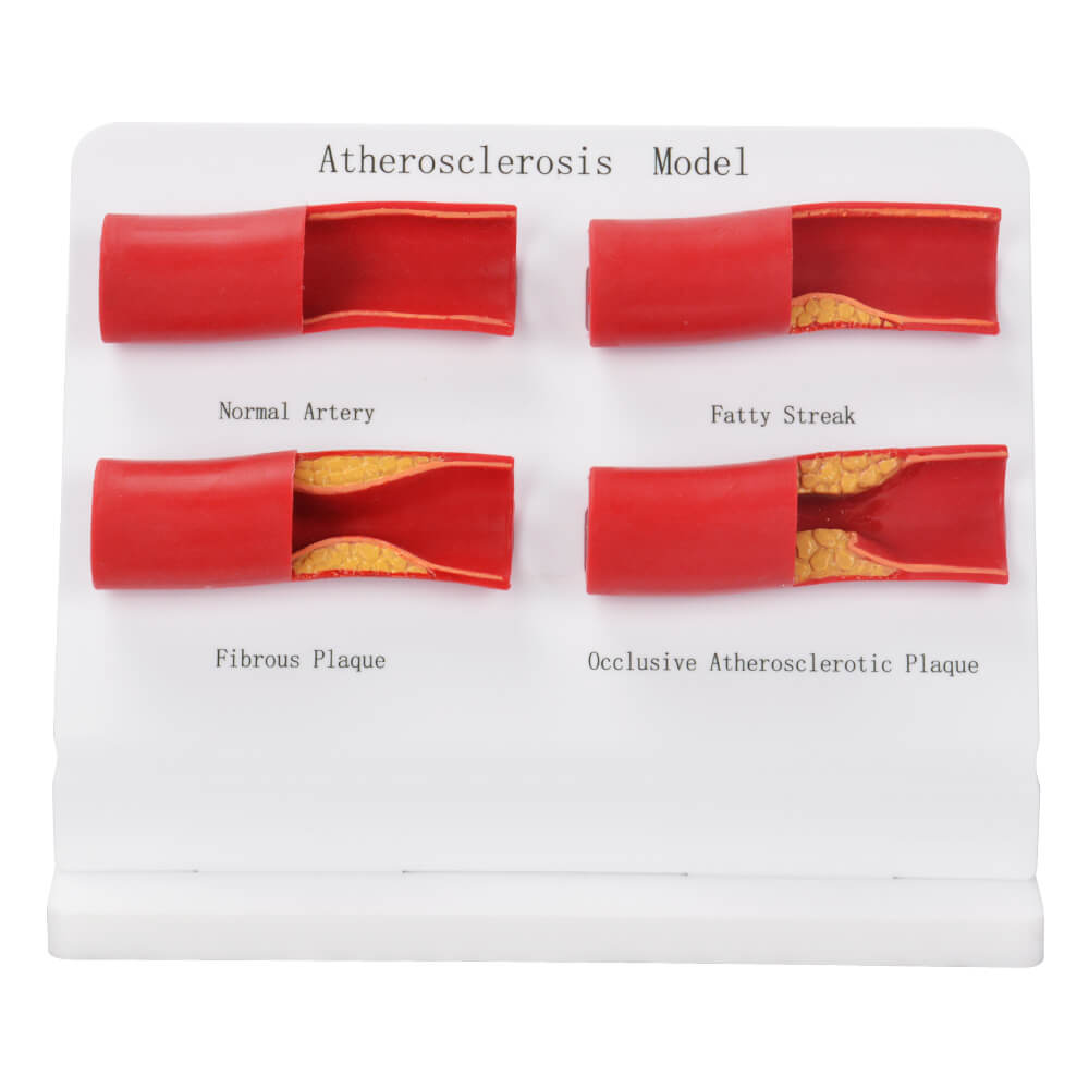 Human Atherosclerosis Model