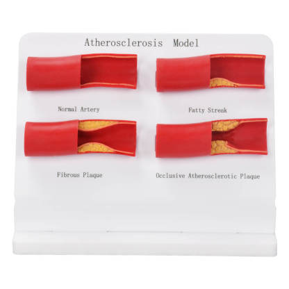 Human Atherosclerosis Model