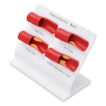 4-Stage Atherosclerosis Artery Model for Education