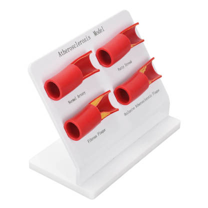 4-Stage Human Atherosclerosis Artery Model for Medical Education