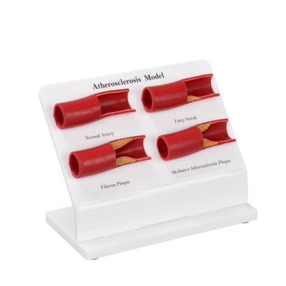 Human Atherosclerosis Artery Model for Education