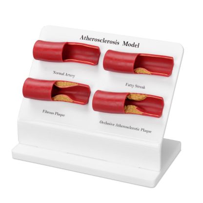 4-Stage Human Atherosclerosis Artery Model for Medical Education