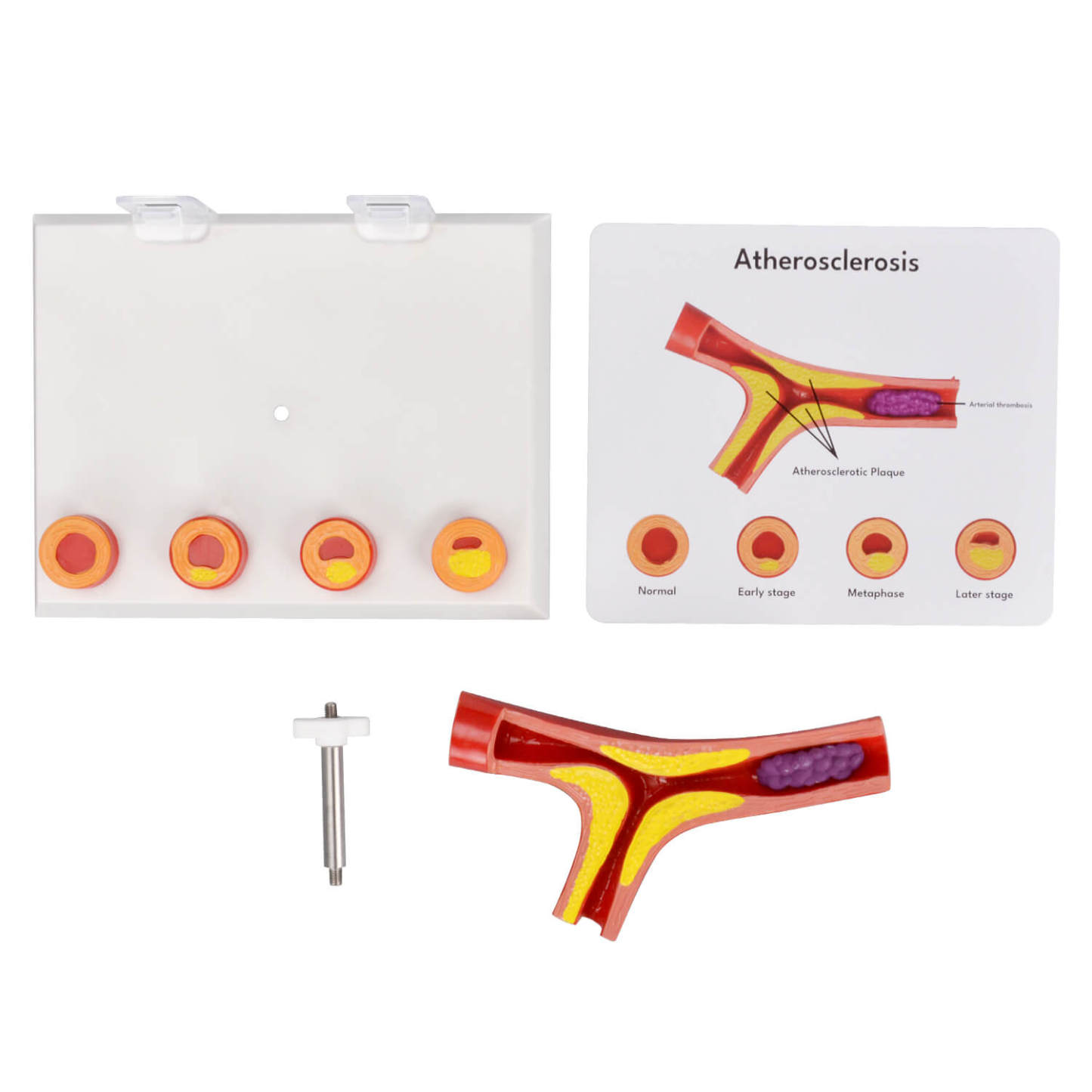 Human Bifurcated Blood Vessel Model with Atherosclerosis Stages