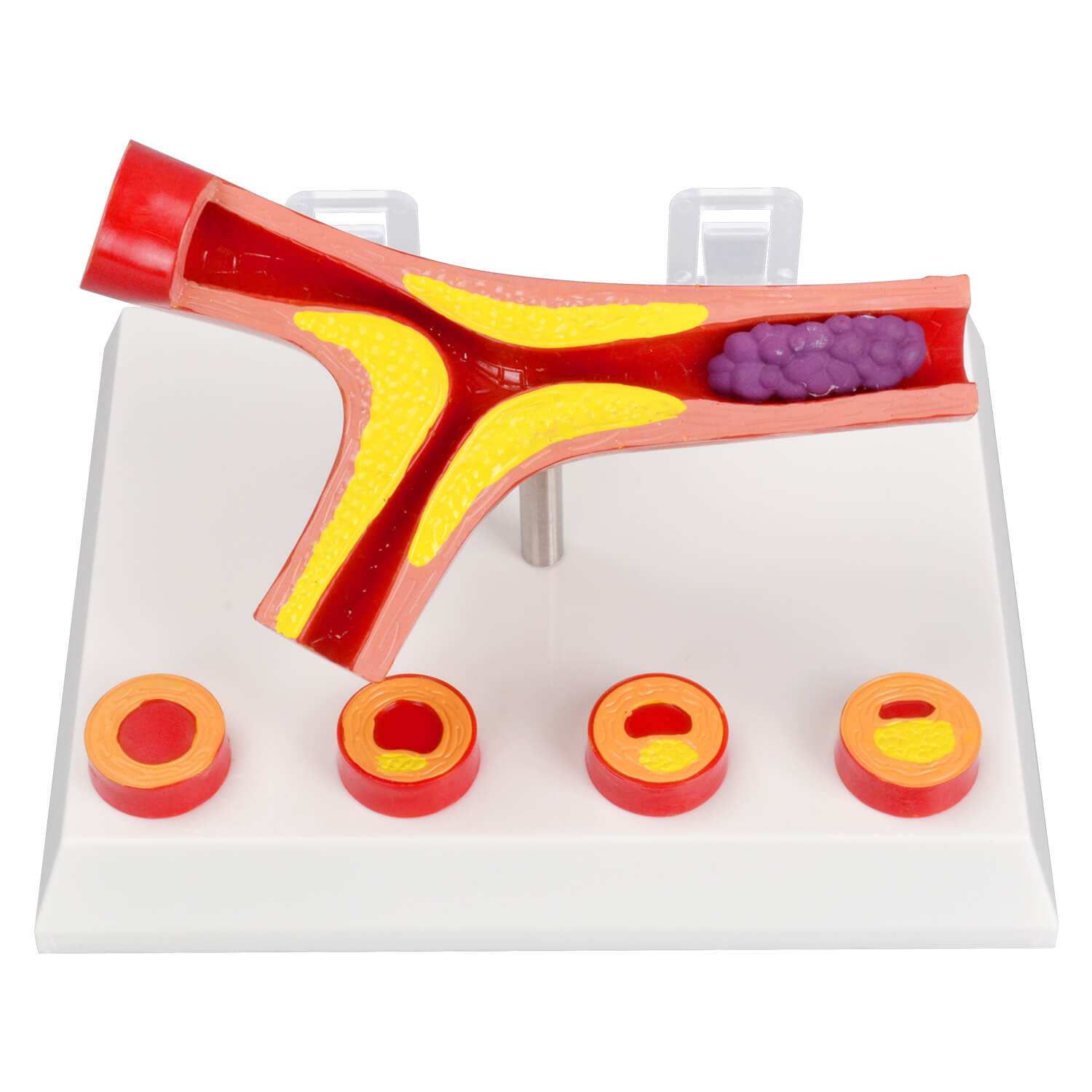 Human Bifurcated Artery Model with Atherosclerosis