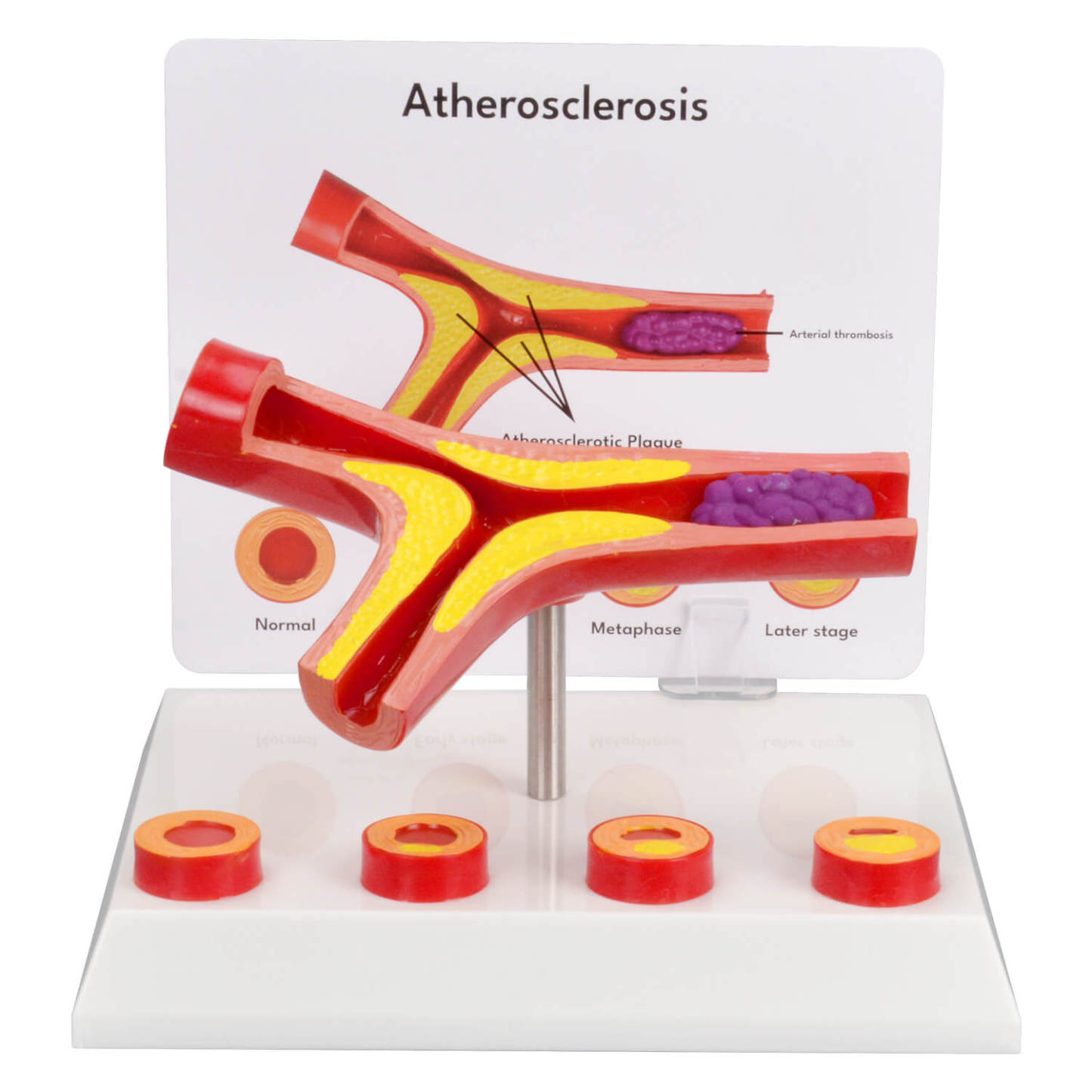 Human Bifurcated Blood Vessel Model with Atherosclerosis Stages