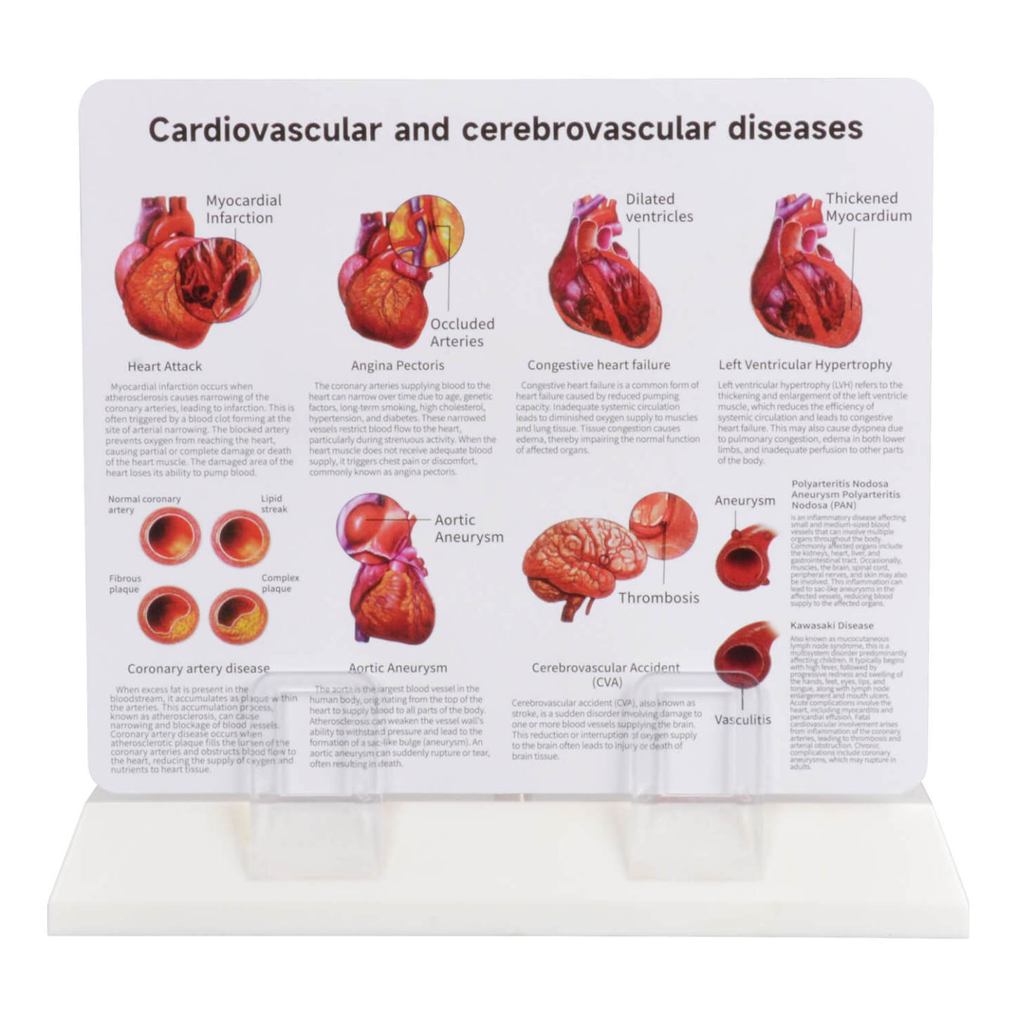 Human Bifurcated Artery Model with Atherosclerosis