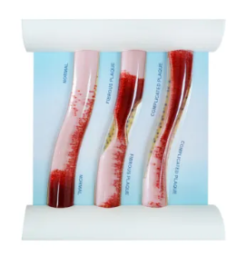 LDL Cholesterol Blood Vessel Model: Normal vs Plaque Stages