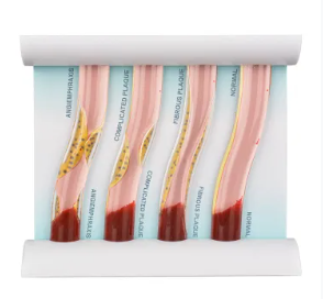 4-Vessel Blood Vessel Blockage Model - Hyperlipidemia Simulation Tool