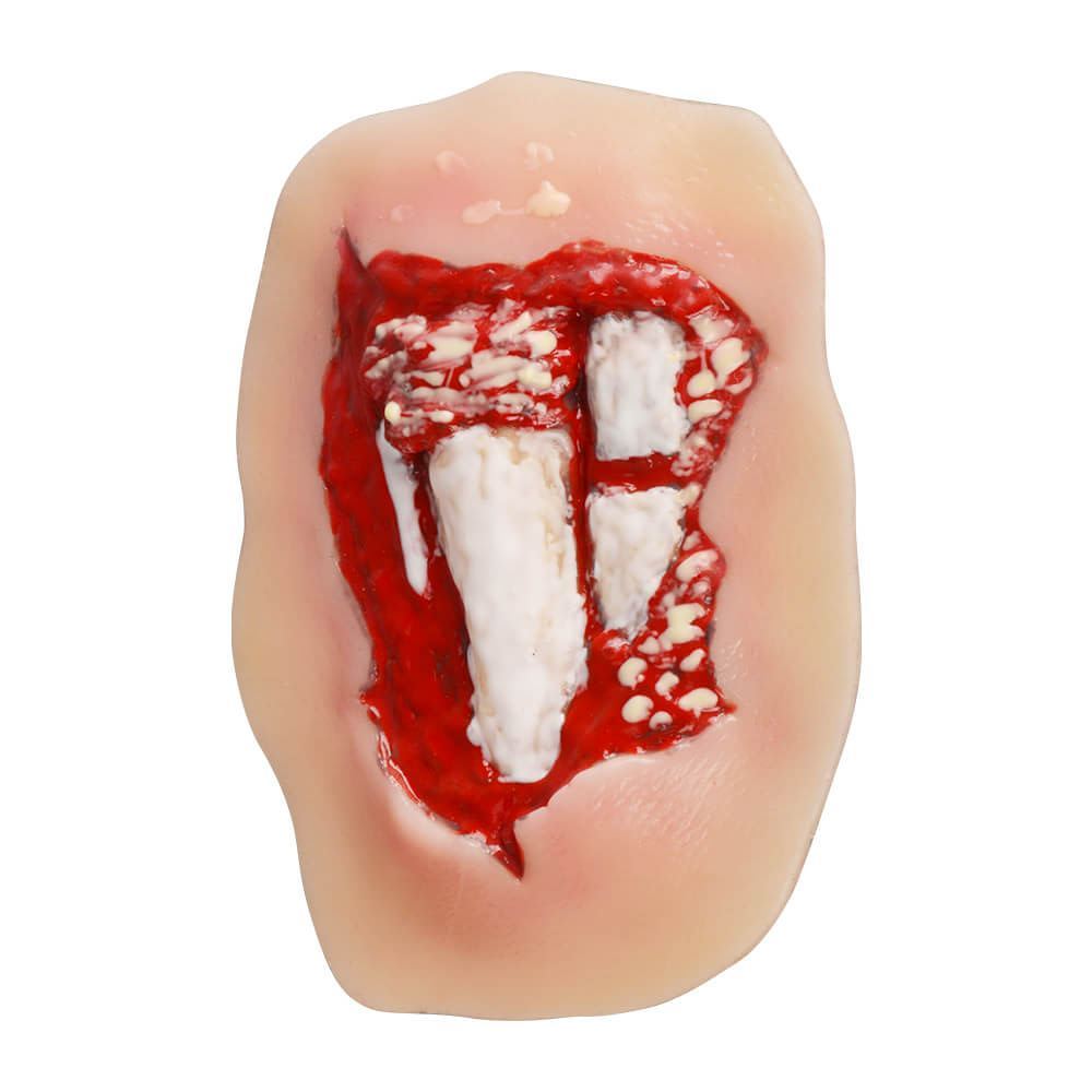 Adhesive Silicone Open Leg Fracture Wound Moulage