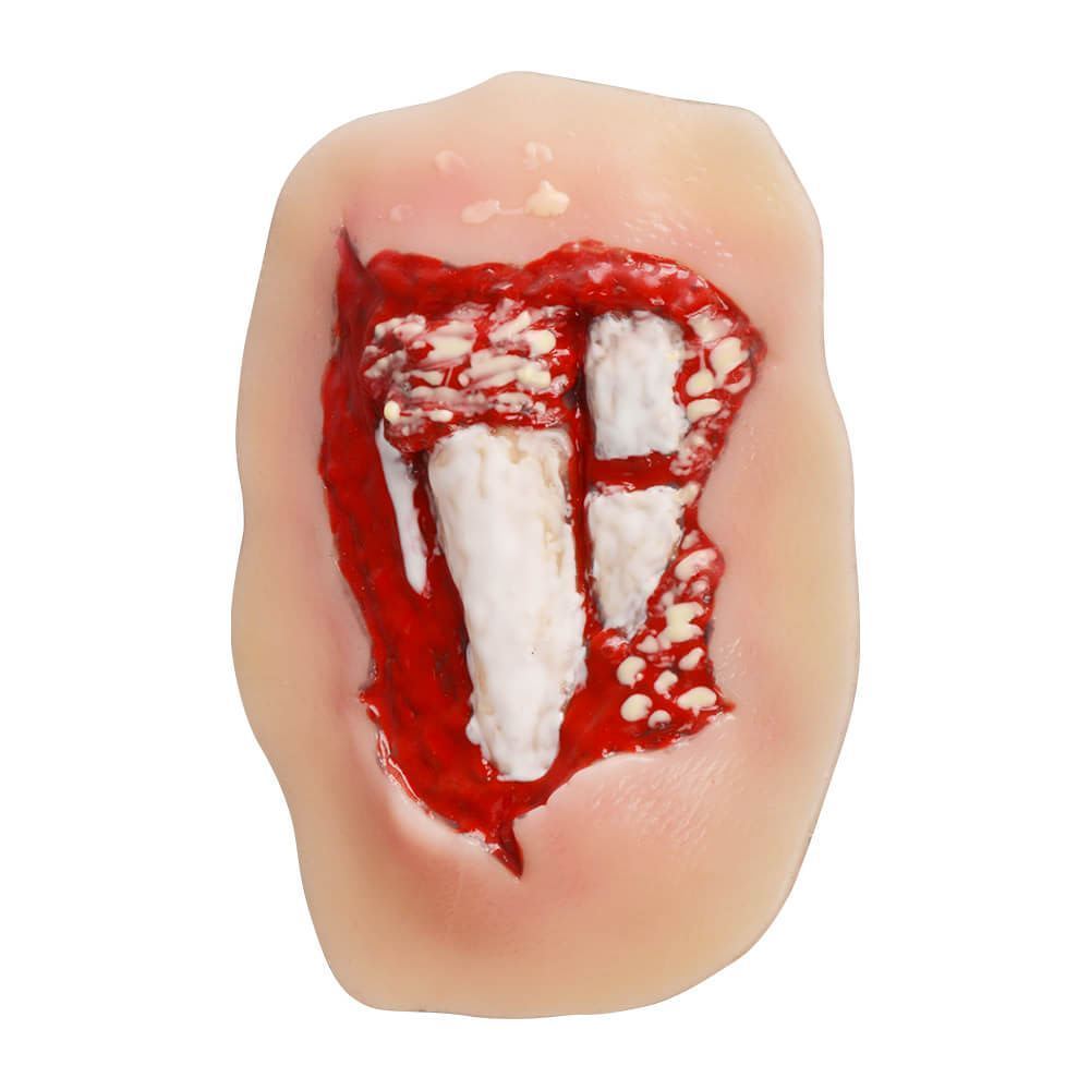 Adhesive Silicone Open Leg Fracture Wound Moulage