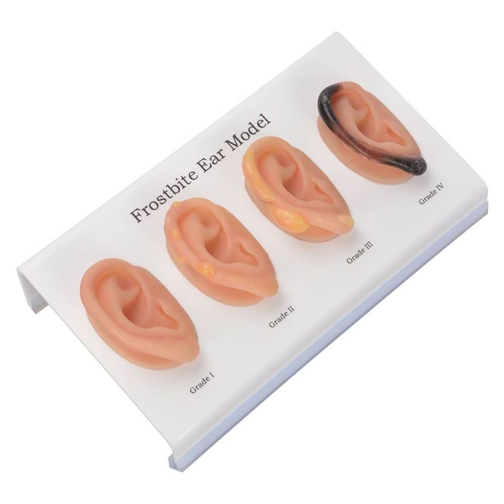 Ear Frostbite Model (Grades I–IV) with Display Stand