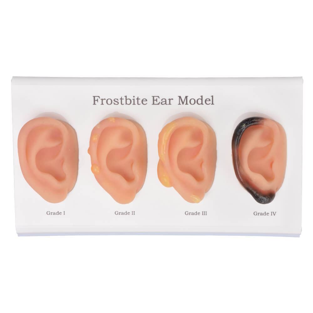 ear frostbite model set of 4