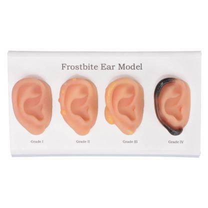 ear frostbite model set of 4